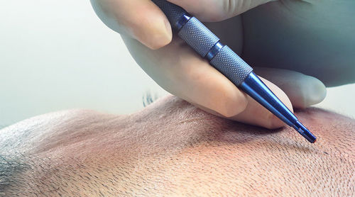 Ultime notizie aziendali su Applicazione delle lame di zaffiro nella chirurgia del trapianto di capelli